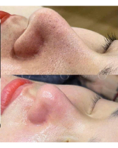 Voucher Làm Sạch Sâu Aqua, Peel Phun O2 Tươi - belovedbeyond.com